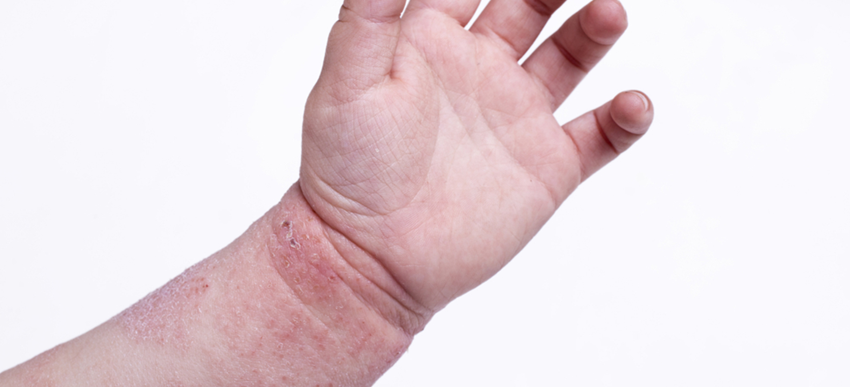 Children's Allergies: What you need to know to reduce the risk of allergies in your child